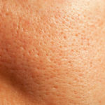 Qu’est-ce que le peeling chimique pour les cicatrices d’acné ?